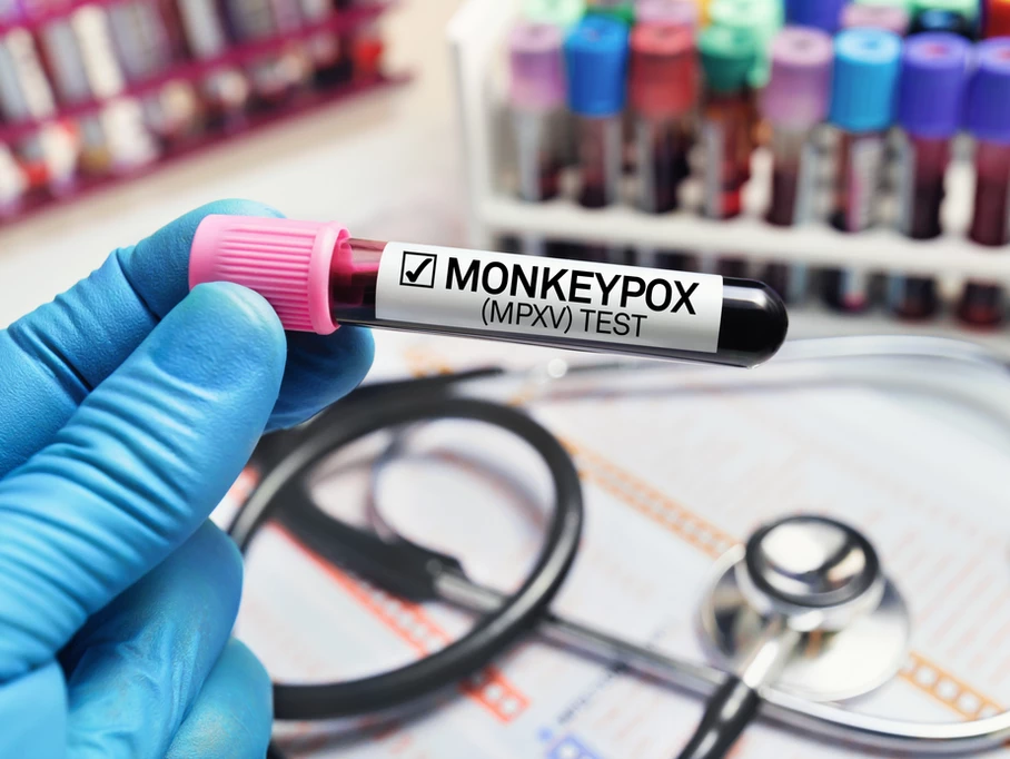 Everything You Need To Know About Monkeypox