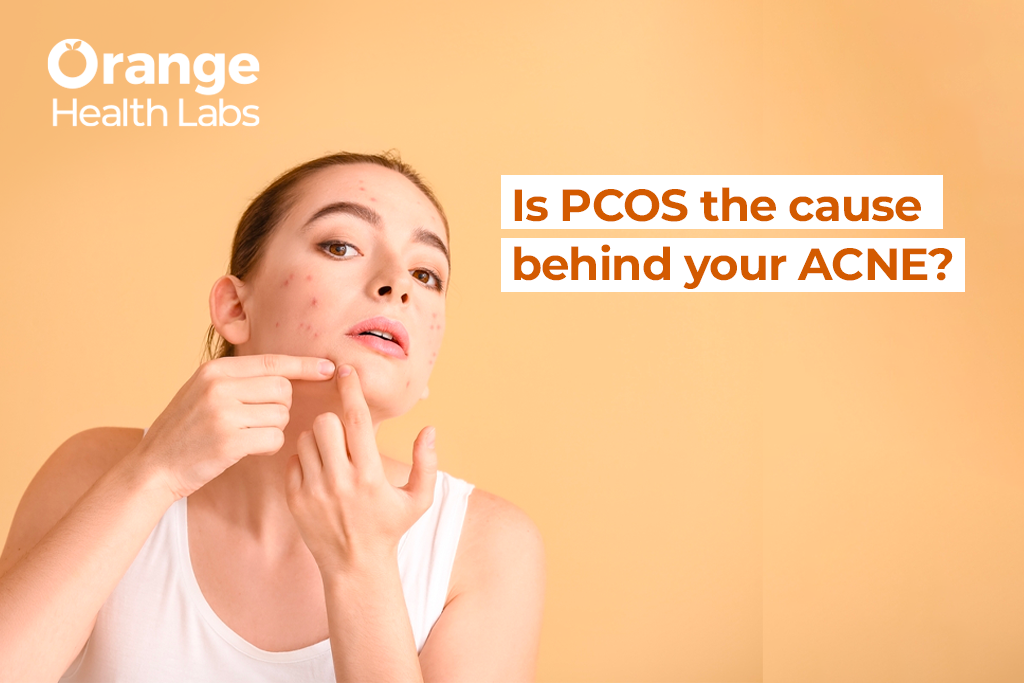 Is PCOS the cause behind your ACNE?