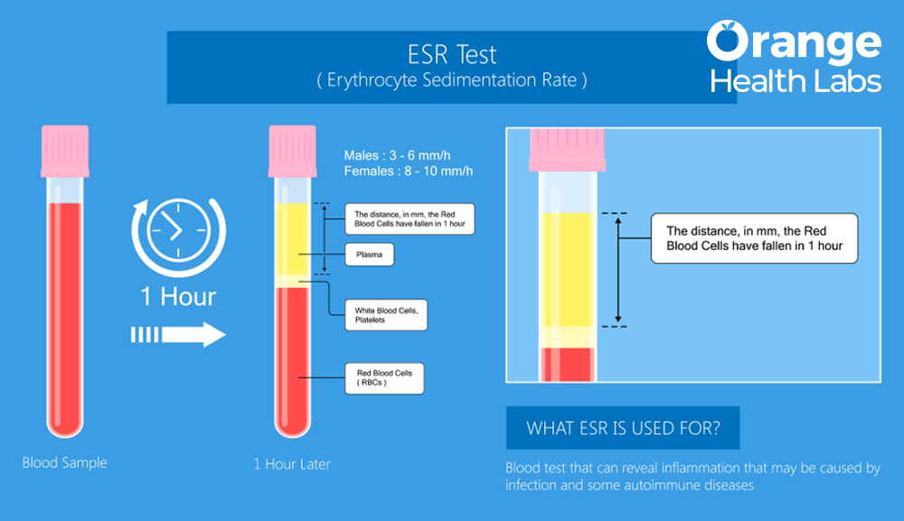 ESR Blood Test: Possible Reasons For High ESR Levels