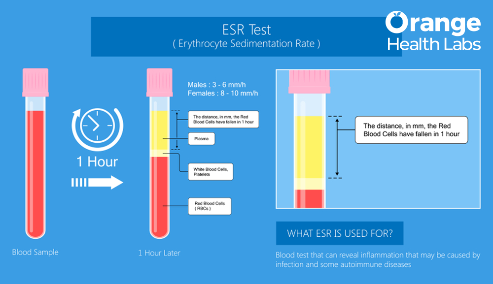 High Erythrocyte Sedimentation Rate (ESR): Unraveling Causes, Symptoms, and Significance