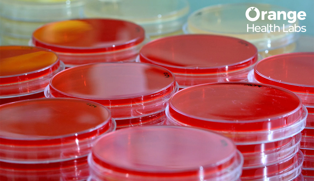 The Role of Blood Culture Tests in Diagnosing Infections